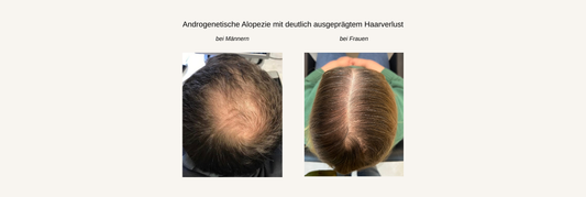 Comparison of androgenetic alopecia hair loss in men and women, top view photographs