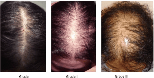 Androgenetische Alopezie (androgenetischer Haarausfall)+Produkte gegen Haarausfall