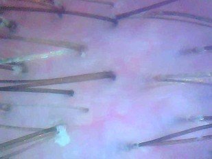 Efficacy study: 1.3 Dixidox de Luxe Peeling – Before