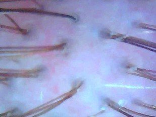 Efficacy study: 1.3 Peeling + 2.1 Dixidox de Luxe Antidandruff Shampoo – Before