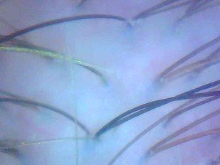 Efficacy study: 1.3 Dixidox de Luxe Peeling – After