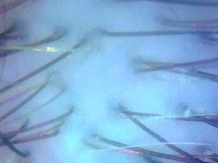 Efficacy study: 1.3 Peeling + 2.1 Dixidox de Luxe Antidandruff Shampoo – After