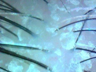 Efficacy study: 1.3 Peeling + 2.1 Dixidox de Luxe Antidandruff Shampoo – Before