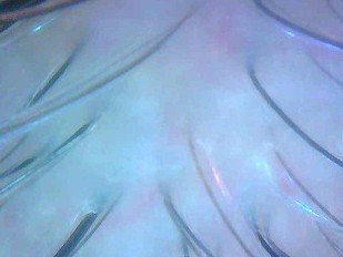 Efficacy study: 1.3 Peeling + 2.1 Dixidox de Luxe Antidandruff Shampoo – After